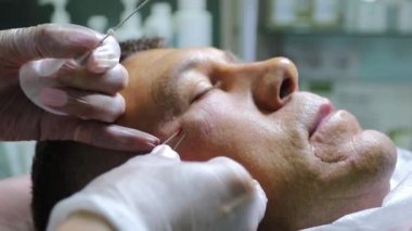 Güzellik enjeksiyonları ile kellik tedavisi. Eldivenli kozmetolojist elleri deri altı enjeksiyonuyguluyor. Plasmalifting erkek hasta.