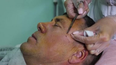 Güzellik enjeksiyonları ile kellik tedavisi. Eldivenli kozmetolojist elleri deri altı enjeksiyonuyguluyor. Plasmalifting erkek hasta.