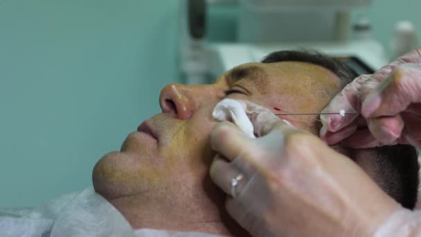 Tratamento da calvície com injeções de beleza. As mãos de cosmetologist em luvas fazem uma injeção subcutânea. Paciente masculino plasmaletizante . — Vídeo de Stock