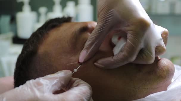 Trattamento della calvizie con iniezioni di bellezza. Cosmetologo mani in guanti fare un'iniezione sottocutanea. Plasmalifting paziente maschile . — Video Stock