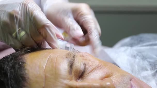 Traitement de la calvitie par injections de beauté. Les mains du cosmétologue dans les gants font une injection sous-cutanée. Patient homme plasmalifteur . — Video