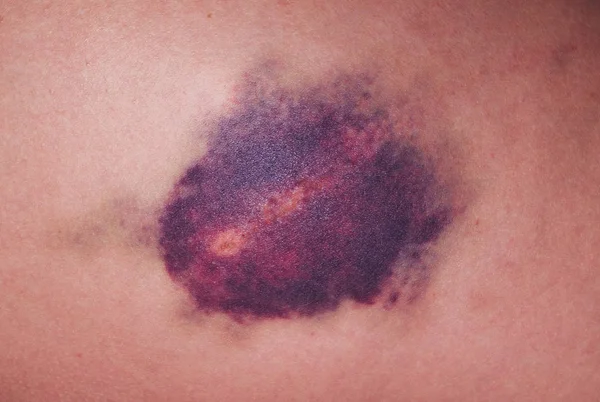 Injury of the knee joint. Big bruise on knee. — Stock Photo, Image