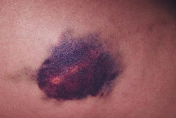 Injury of the knee joint. Big bruise on knee. — Stock Photo, Image