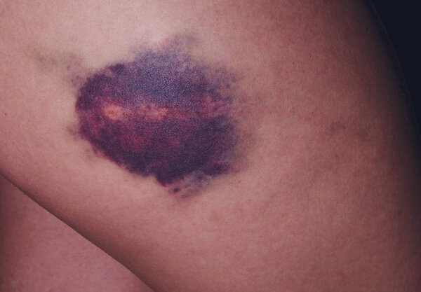 Травма коленного сустава. Большой синяк на коленях
.