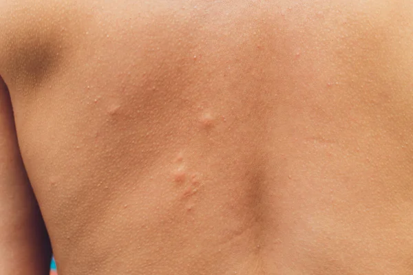 A mans back bite of a mosquito on the background of a mall. — Stock Photo, Image