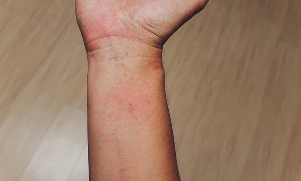 Красные волдыри на руке и дерматиты, зуд от аллергии, кожных заболеваний или насекомых, ядовитые укусы животных . — стоковое фото