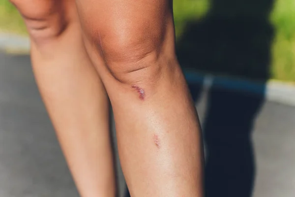 Primer plano de la rodilla femenina con una cicatriz . —  Fotos de Stock