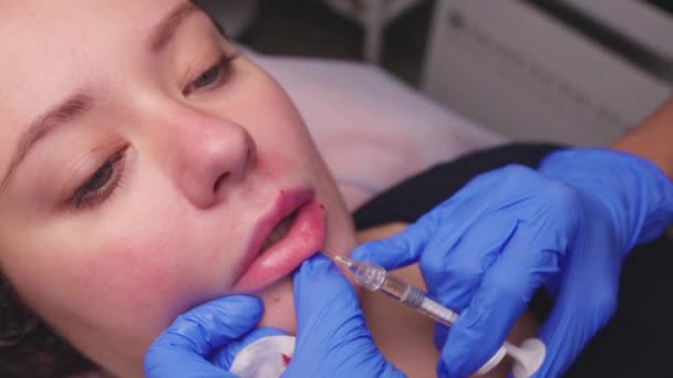 Молода жінка отримує ін'єкції в губи, крупним планом . — стокове відео