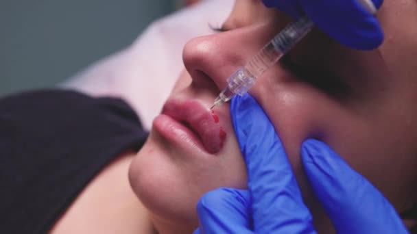 Jeune femme recevant une injection dans les lèvres, gros plan. — Video