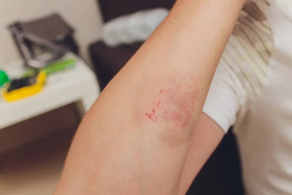 Abrasion on the underarm which occured in outdoor sports. — Stock Photo, Image