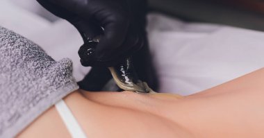 Şekerleme: Koltukaltında sıvı şekerli epilasyon. Balmumu değişimiyle daha az acı verici olur..