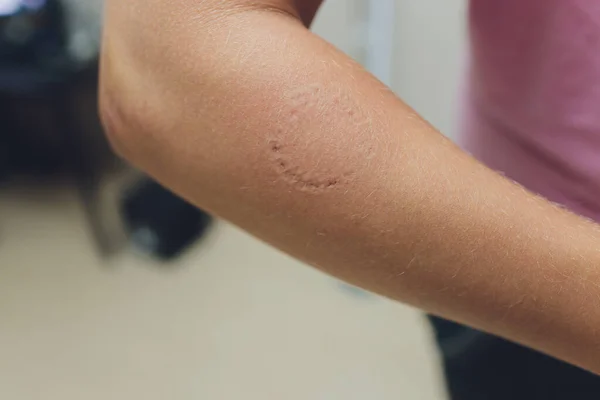 Toddlers bite marks on mothers arm - aggressive toddlers behavior psychology.