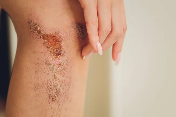 Dois arranhão ferida no joelho feminino com grande cicatriz close-up, cuidados de saúde e medicina conceito . — Fotografia de Stock