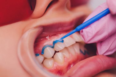 Diş beyazlatma için dişçiye giden bir kadının yakın plan portresi, diş beyazlatma prosedürü..