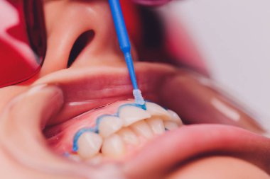 Diş beyazlatma için dişçiye giden bir kadının yakın plan portresi, diş beyazlatma prosedürü..