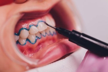 Diş beyazlatma için dişçiye giden bir kadının yakın plan portresi, diş beyazlatma prosedürü..