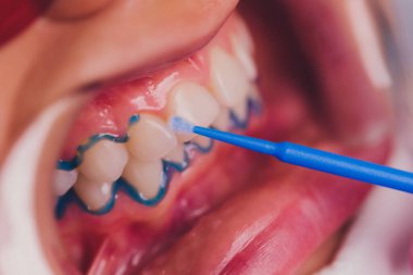 Diş beyazlatma için dişçiye giden bir kadının yakın plan portresi, diş beyazlatma prosedürü..