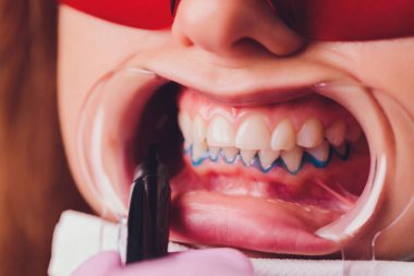 Diş beyazlatma için dişçiye giden bir kadının yakın plan portresi, diş beyazlatma prosedürü..