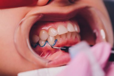 Diş hekimi hastaların diş gölgesiyle beyazlatma tedavisini karşılaştırıyor..