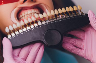 Diş hekimi hastaların diş gölgesiyle beyazlatma tedavisini karşılaştırıyor..