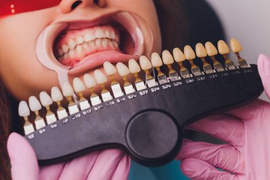 Diş hekimi hastaların diş gölgesiyle beyazlatma tedavisini karşılaştırıyor..