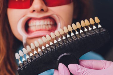 Diş hekimi hastaların diş gölgesiyle beyazlatma tedavisini karşılaştırıyor..