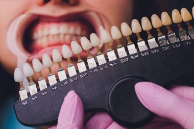 Diş hekimi hastaların diş gölgesiyle beyazlatma tedavisini karşılaştırıyor..