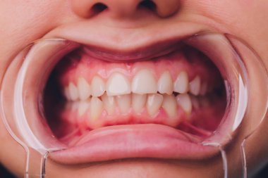 Diş beyazlatma için dişçiye giden bir kadının yakın plan portresi, diş beyazlatma prosedürü..