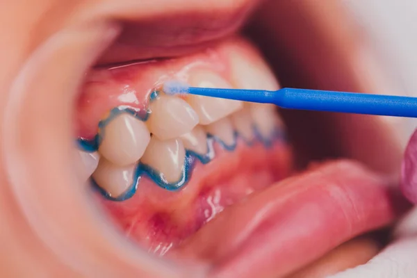 Close-up portret van een vrouwelijke patiënt bezoeken tandarts voor het bleken van tanden in kliniek, Teeth whitening procedure. — Stockfoto