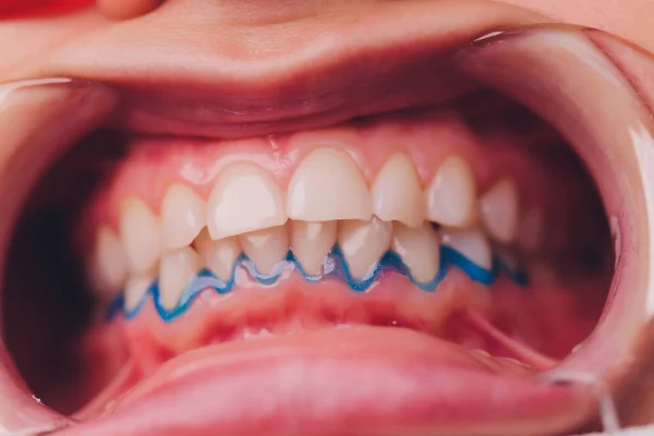 Close-up retrato de uma paciente do sexo feminino visitando dentista para clareamento dos dentes na clínica, procedimento de clareamento dos dentes. — Fotografia de Stock