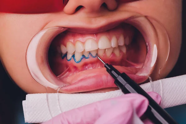 Retrato de cerca de una paciente femenina que visita al dentista para blanquear los dientes en la clínica, procedimiento de blanqueamiento dental. — Foto de Stock
