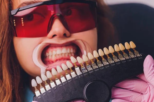 O dentista comparando pacientes sombra de dentes com amostras para o tratamento de branqueamento. — Fotografia de Stock