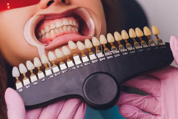 Diş hekimi hastaların diş gölgesiyle beyazlatma tedavisini karşılaştırıyor..