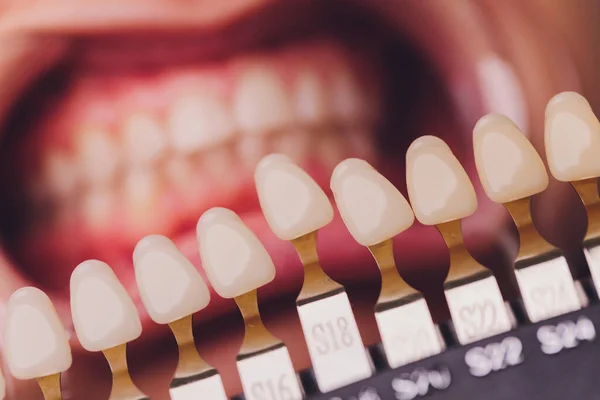 A fogorvos összehasonlítja a betegek fogainak árnyalatát a fehérítő kezelés mintáival. — Stock Fotó