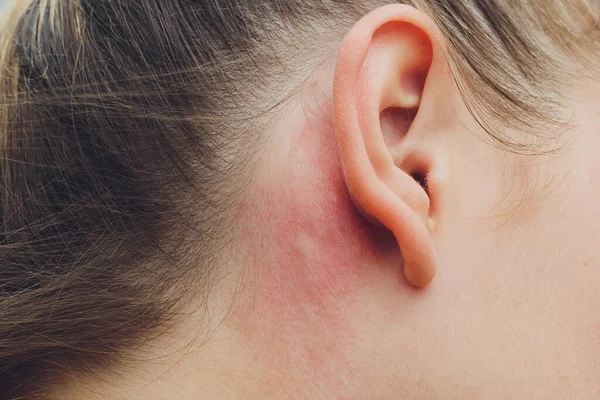 Аллергическая реакция кожи на человека за ухом, вызванная стафилинидами насекомых, ожоги на коже. — стоковое фото