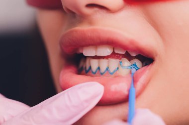 Diş beyazlatma için dişçiye giden bir kadının yakın plan portresi, diş beyazlatma prosedürü..