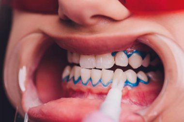 Diş beyazlatma için dişçiye giden bir kadının yakın plan portresi, diş beyazlatma prosedürü..