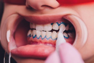 Diş beyazlatma için dişçiye giden bir kadının yakın plan portresi, diş beyazlatma prosedürü..