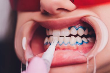 Diş beyazlatma için dişçiye giden bir kadının yakın plan portresi, diş beyazlatma prosedürü..