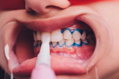 Diş beyazlatma için dişçiye giden bir kadının yakın plan portresi, diş beyazlatma prosedürü..