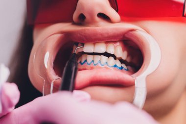 Diş beyazlatma için dişçiye giden bir kadının yakın plan portresi, diş beyazlatma prosedürü..