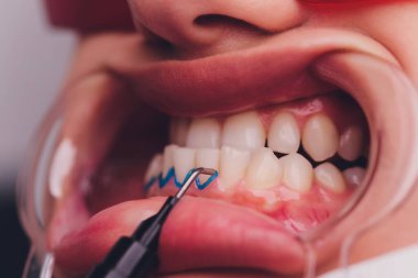 Diş beyazlatma için dişçiye giden bir kadının yakın plan portresi, diş beyazlatma prosedürü..