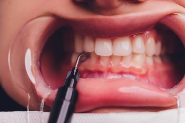 Diş beyazlatma için dişçiye giden bir kadının yakın plan portresi, diş beyazlatma prosedürü..