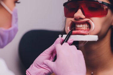 Diş hekimi hastaların diş gölgesiyle beyazlatma tedavisini karşılaştırıyor..