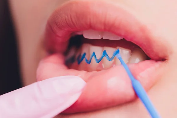 Close-up portret van een vrouwelijke patiënt bezoeken tandarts voor het bleken van tanden in kliniek, Teeth whitening procedure. — Stockfoto