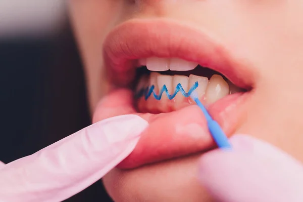 Close-up portret van een vrouwelijke patiënt bezoeken tandarts voor het bleken van tanden in kliniek, Teeth whitening procedure. — Stockfoto