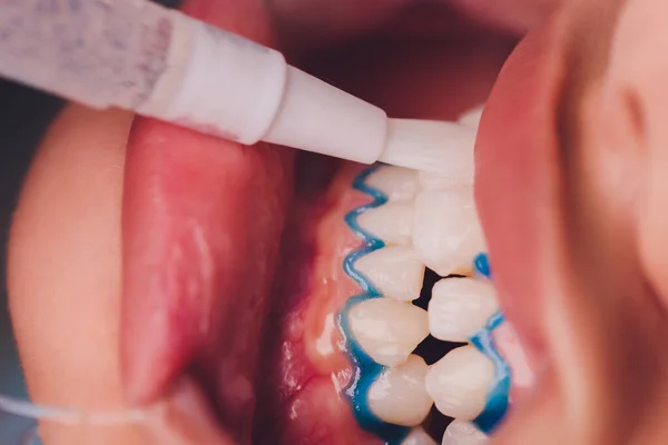 Close-up portret van een vrouwelijke patiënt bezoeken tandarts voor het bleken van tanden in kliniek, Teeth whitening procedure. — Stockfoto