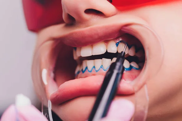 Portrait en gros plan d'une patiente en visite chez le dentiste pour le blanchiment des dents en clinique, procédure de blanchiment des dents. — Photo