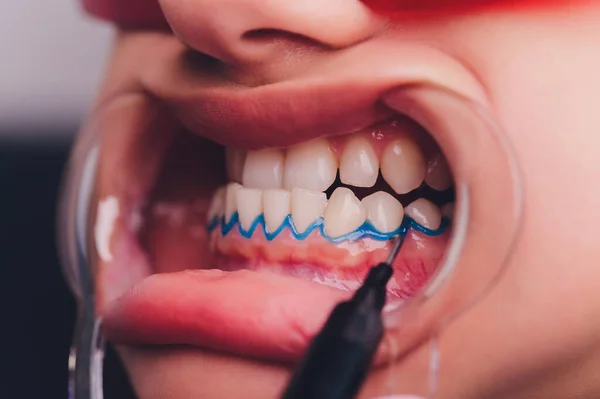 Zbliżenie portret pacjentki odwiedzającej stomatologa do wybielania zębów w klinice, zabieg wybielania zębów. — Zdjęcie stockowe