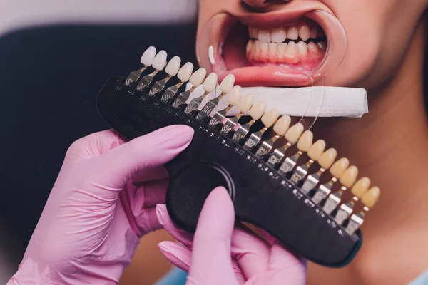 De tandarts vergelijkt patiënten tanden schaduw met monsters voor bleken behandeling. — Stockfoto